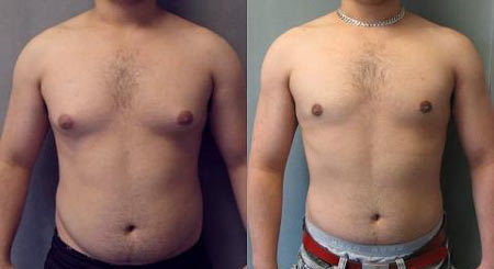 gynecomastia2-min