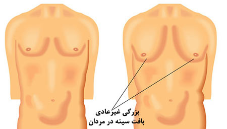 gynecomastia3-min