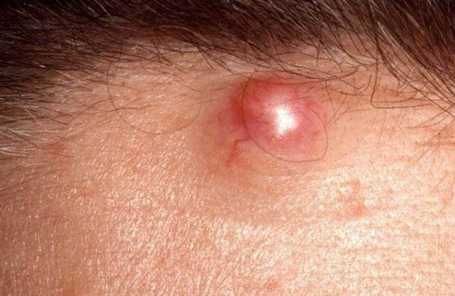 بیماری پوستی کورک (دمل): علت، تشخیص و درمان - لیفت و کشیدن پوست