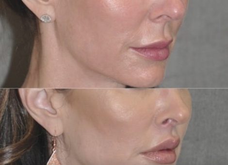 لیفت-لب-به-کمک-روش-گال-وین-