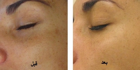 نتایج هیدرودرم ابریژن